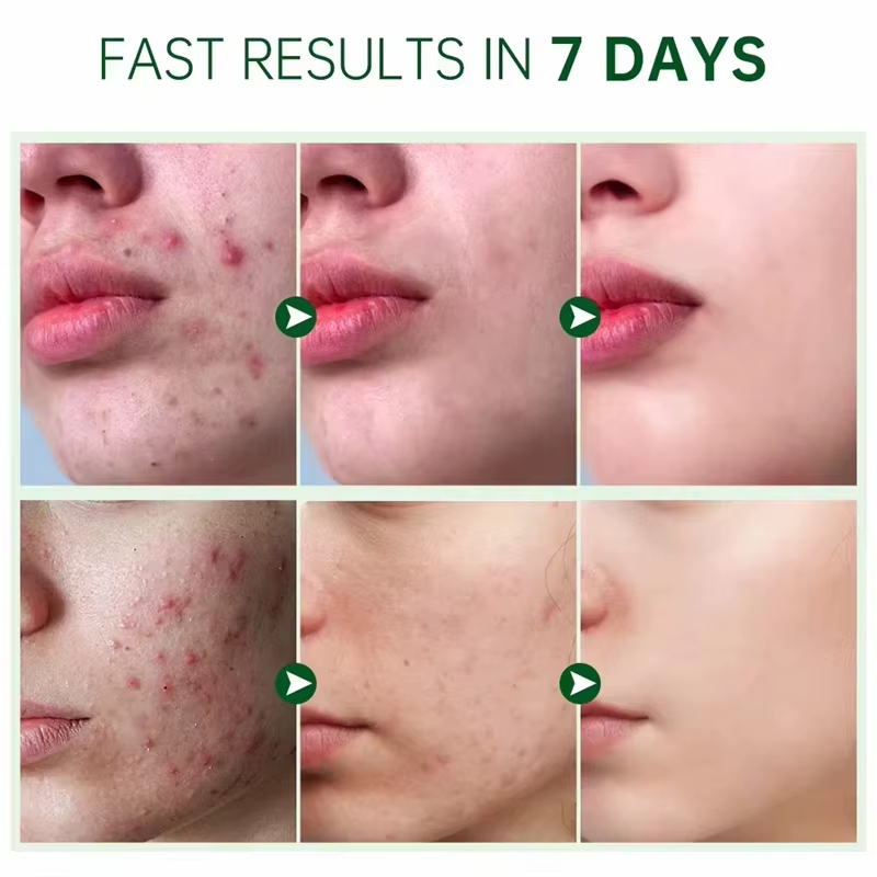Salicylic Acid Acne Face Cream