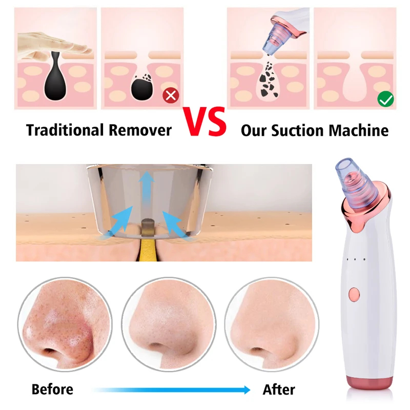 Blackhead Vacuum Pore Cleaner