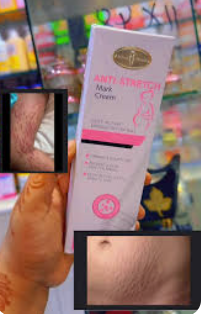 Aichun Beauty Anti-Stretch Mark Cream 100 g